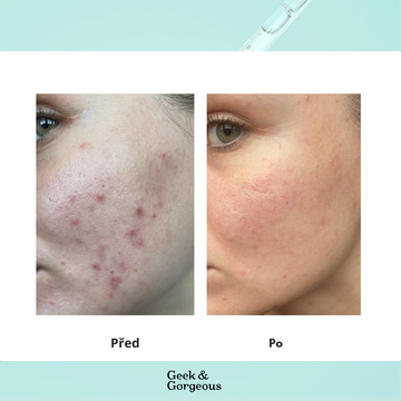 Jak se zbavit hormonálního akné šetrně?